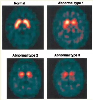 Difference between normal and abnormal brain image